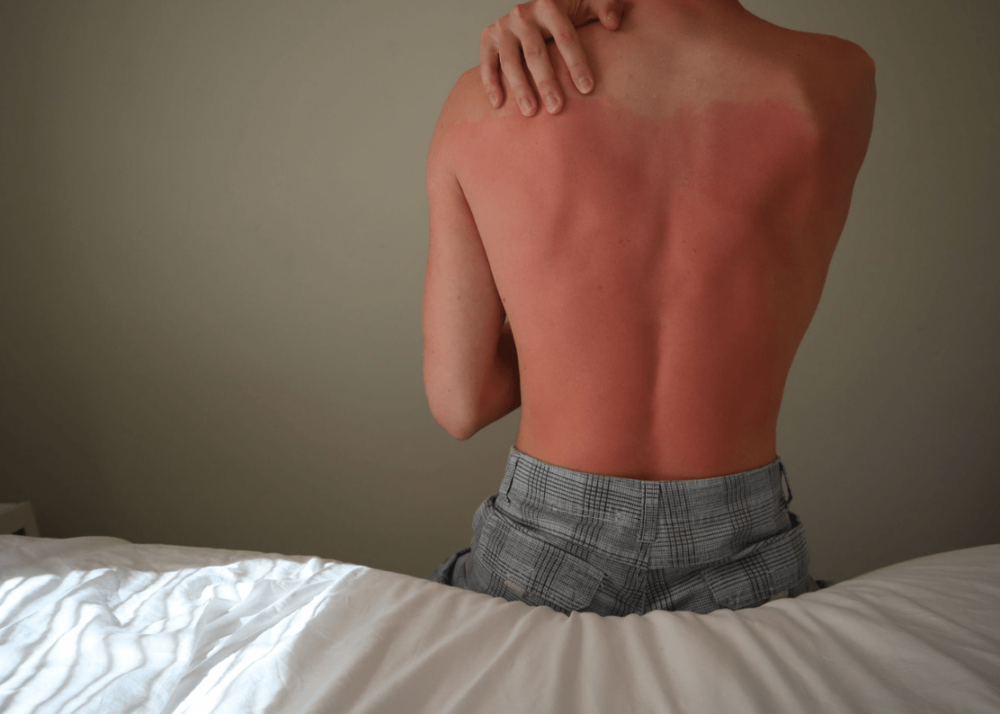 Can Cannabis & CBD Help With My Sunburn?