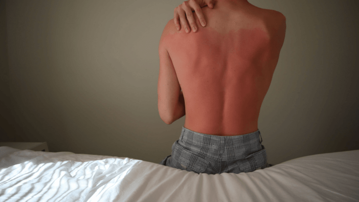 Can Cannabis & CBD Help With My Sunburn?